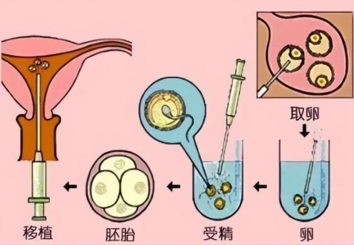 供卵供精试管婴儿【供卵供精试管婴儿：新生命的奇迹】